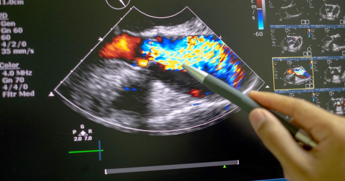 Echocardiography