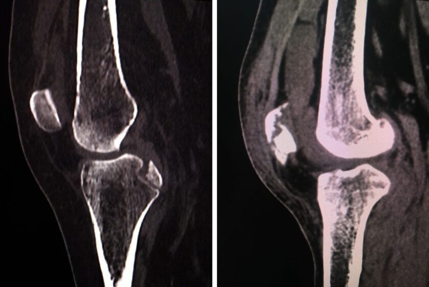 osteoporosis symptoms