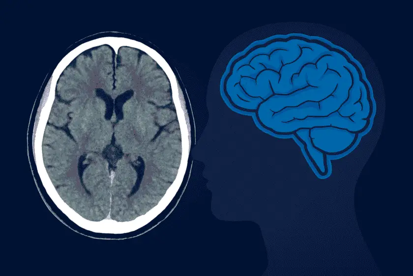 CT Scan Brain