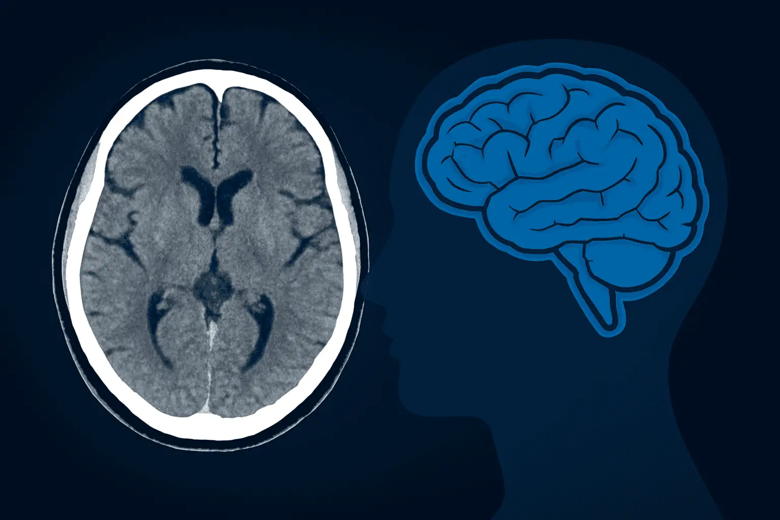 CT Scan Brain