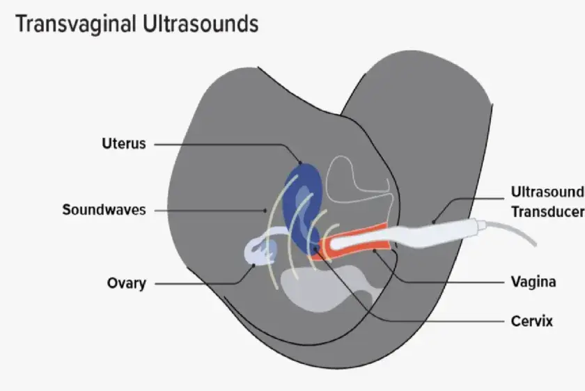 TVS ultrasound