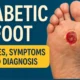 Diabetic Foot